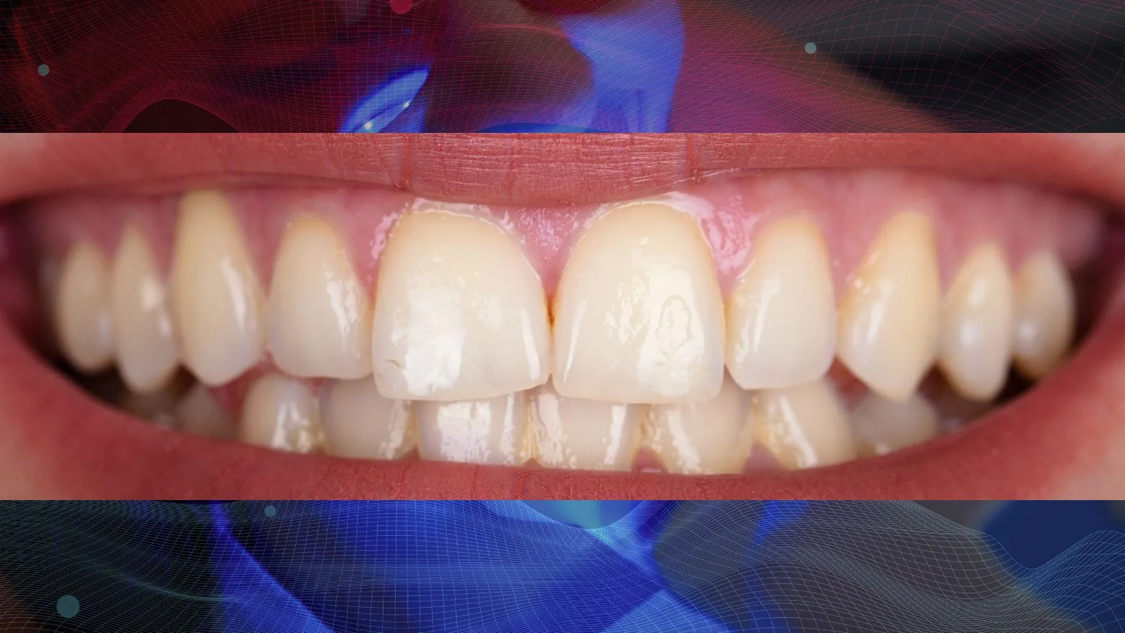 Antes del blanqueamiento dental