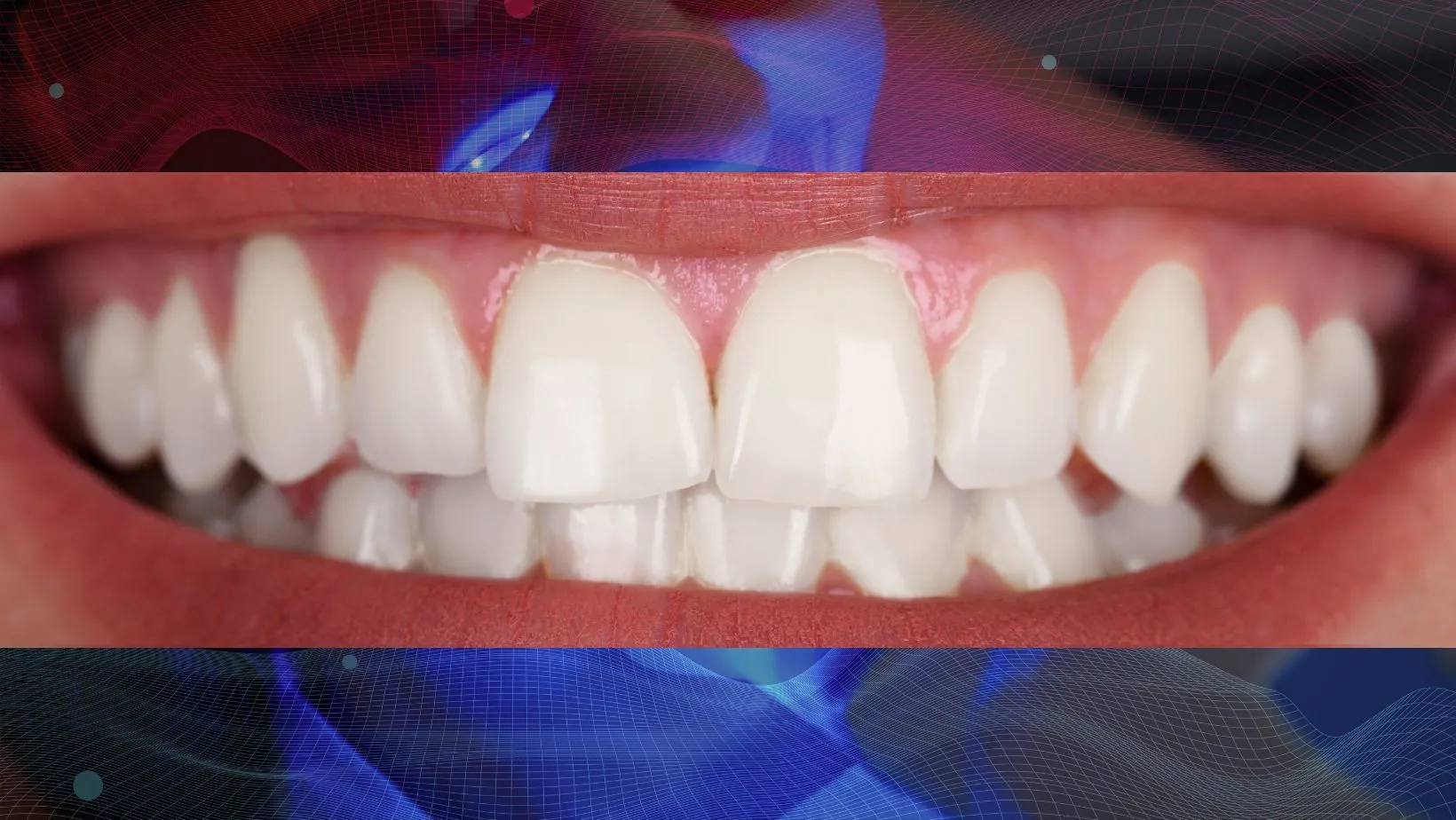 Después del blanqueamiento dental