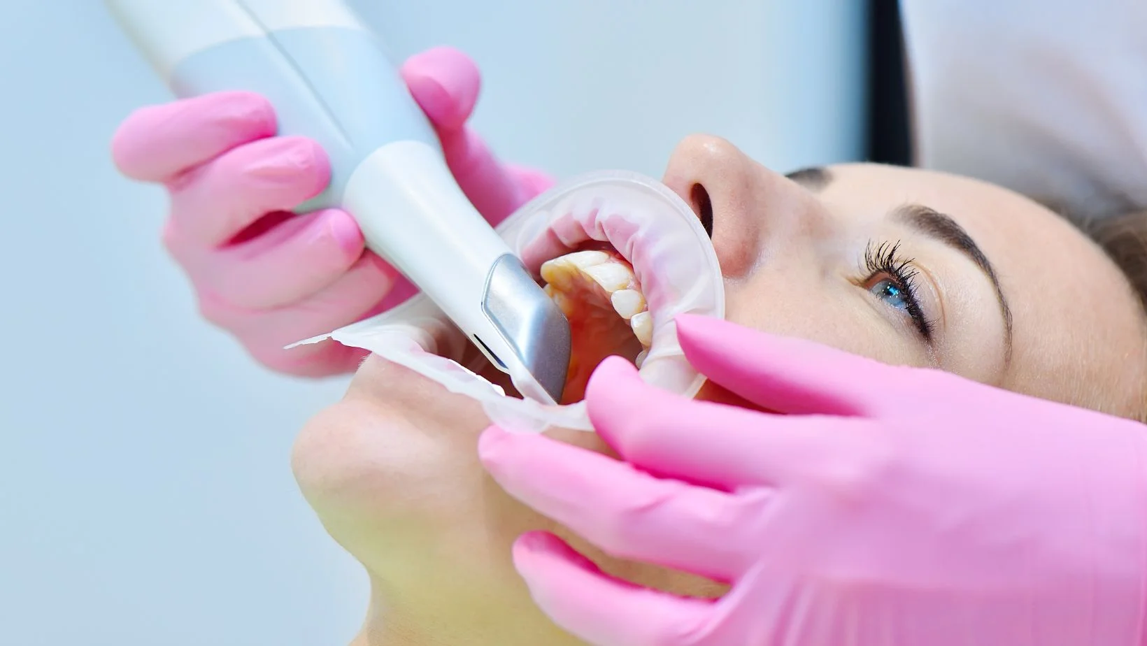 Puente fijo soportado en implantes: resultado clínico