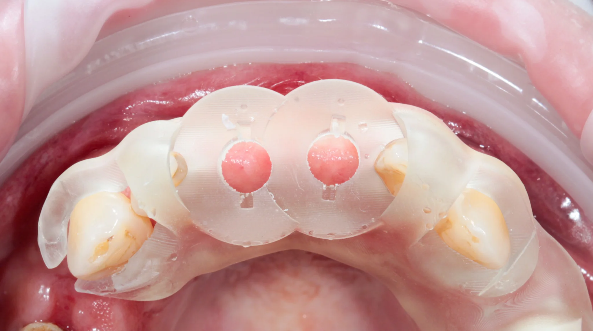 Caso de implante dental en Veracruz: antes y después