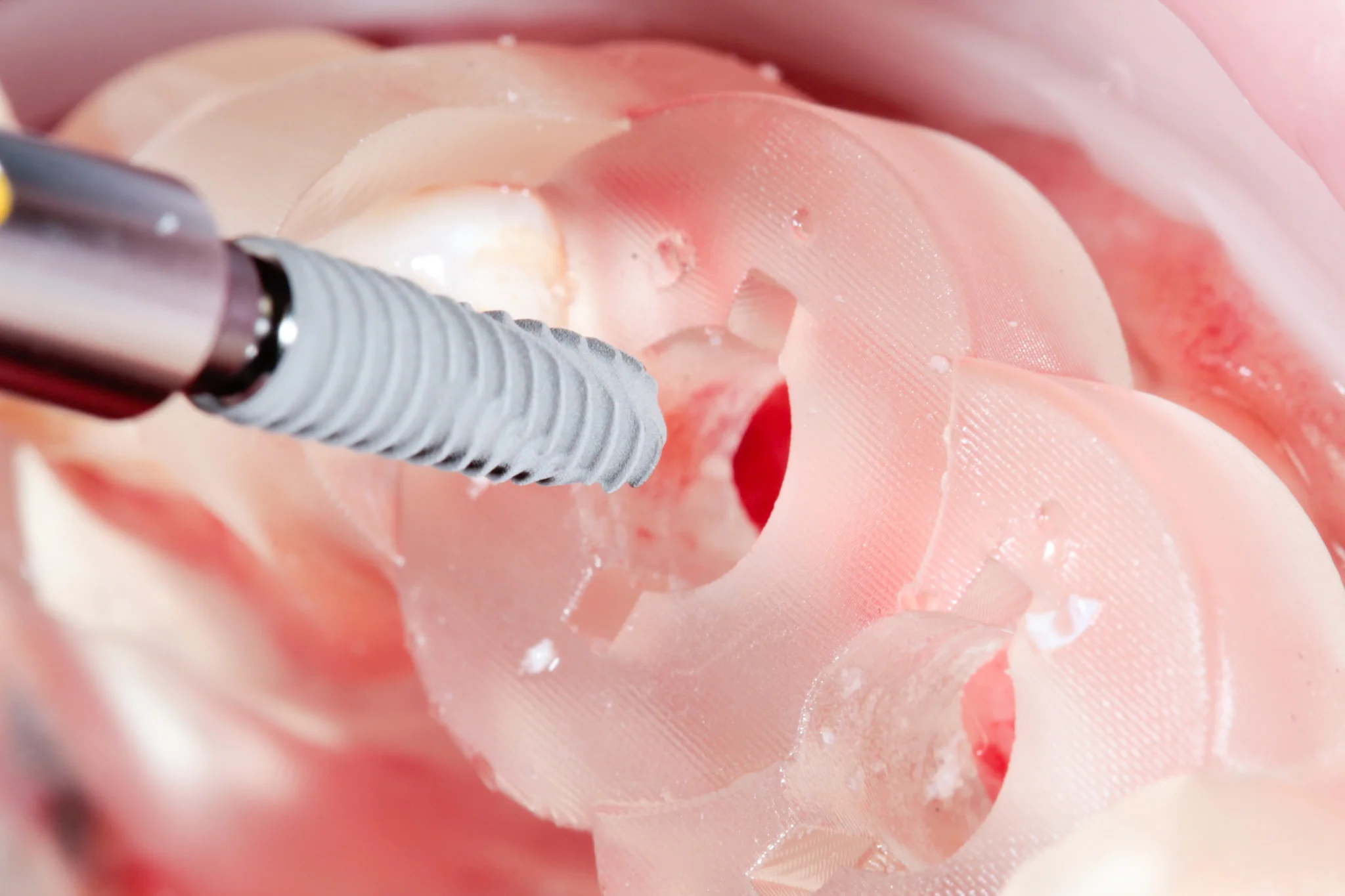 Prótesis híbrida atornillada sobre implantes