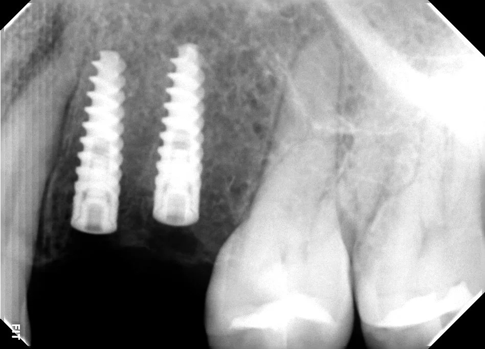 Implante dental explicado: pilar, pilar protésico y corona en Veracruz