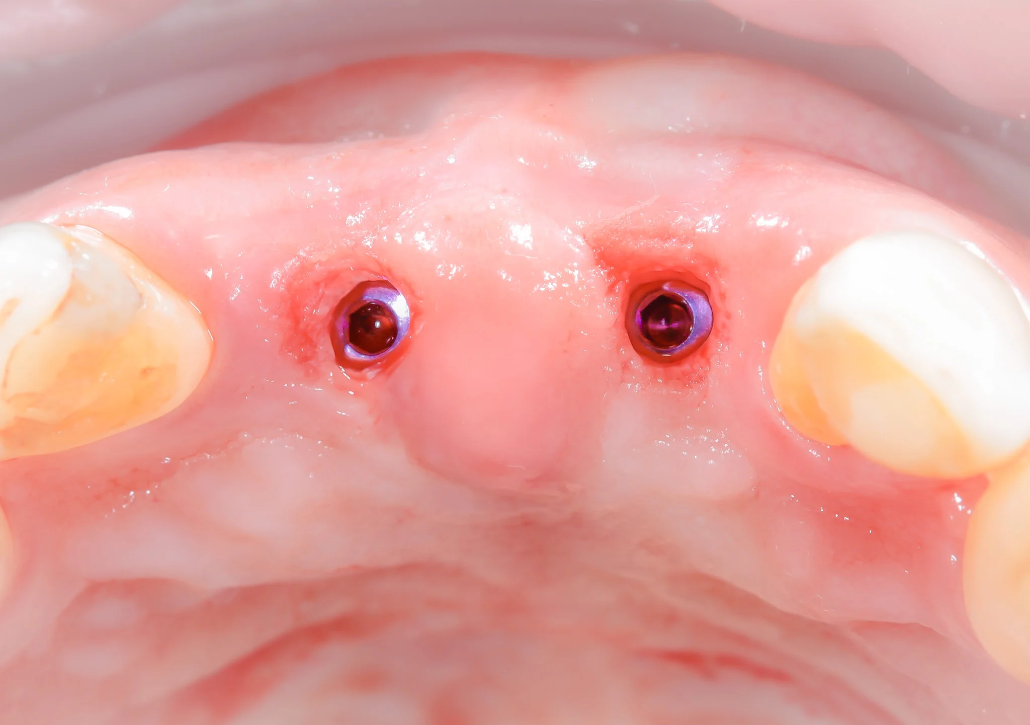 Puente fijo sobre implantes