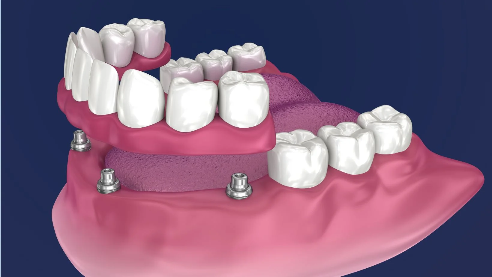 Sobredentadura retenida a implantes con anclajes tipo locator