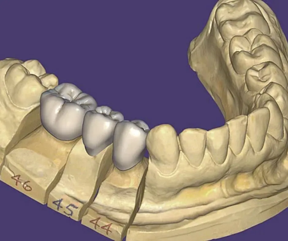 Diseño CAD/CAM