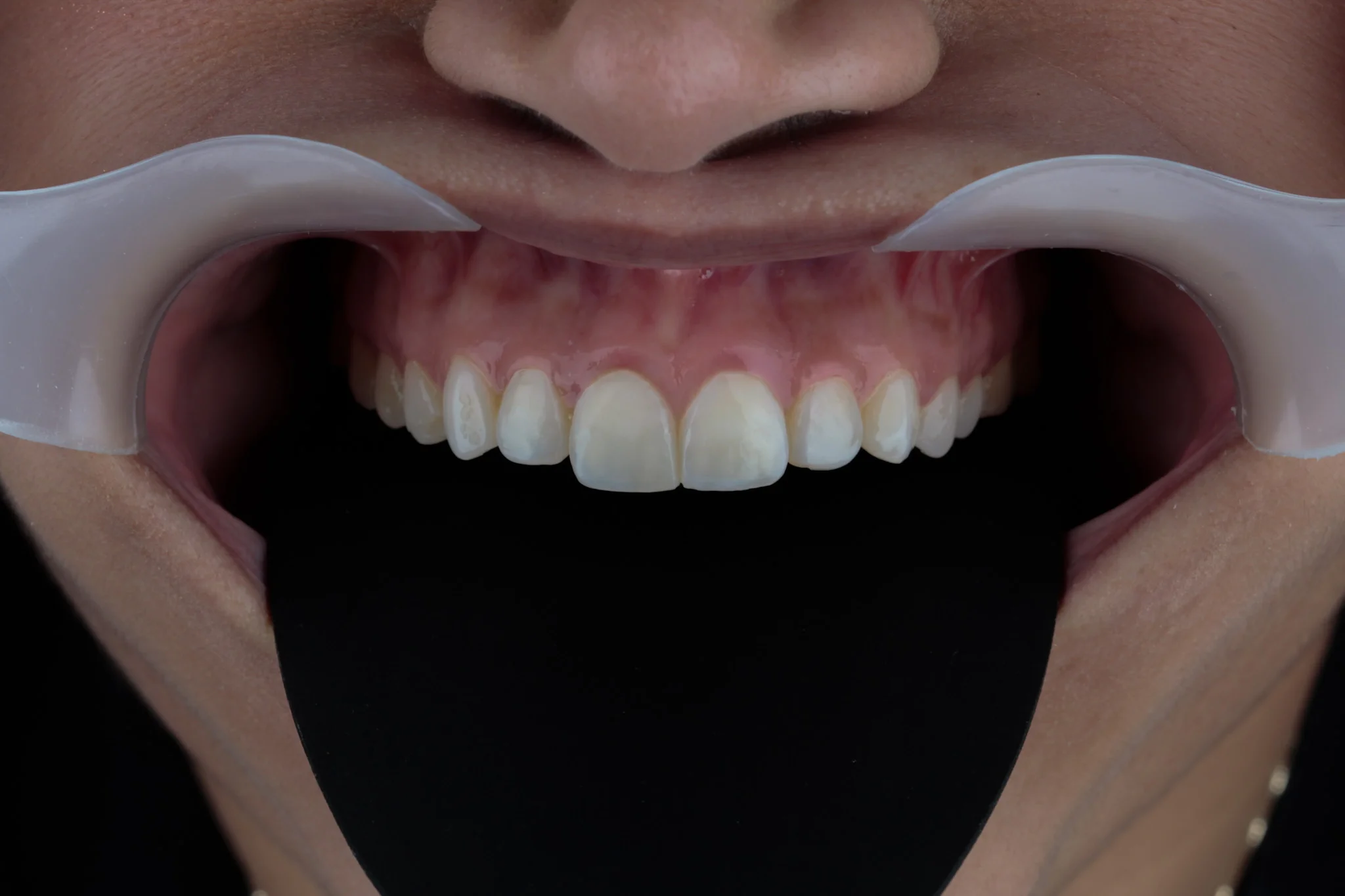 Brackets estéticos de zafiro en dientes