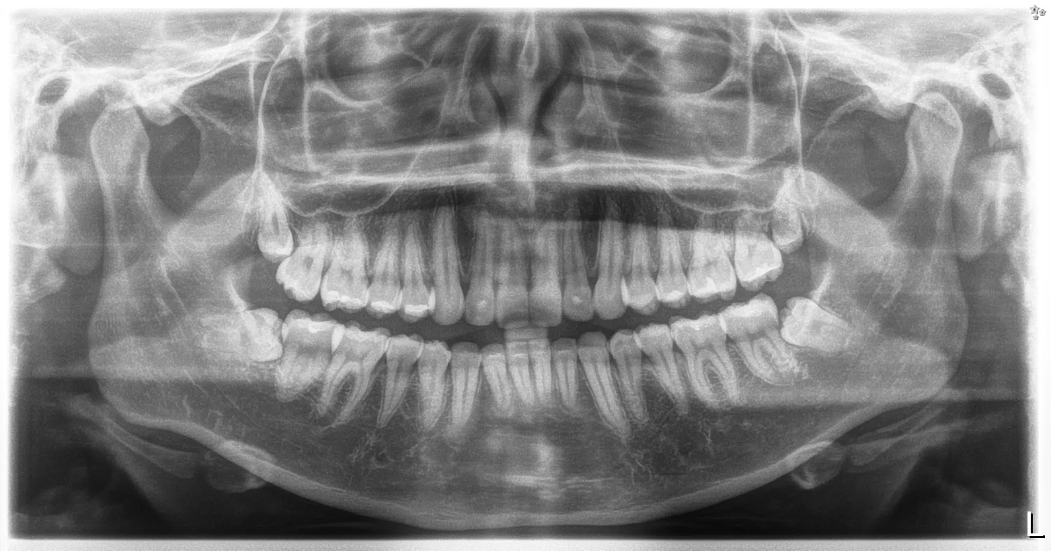 Radiografía panorámica de tercer molar