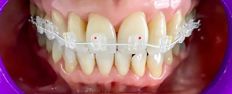 Brackets estéticos de zafiro