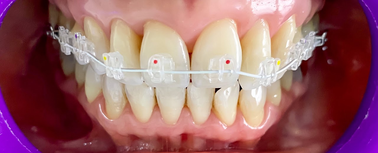 Brackets estéticos de zafiro