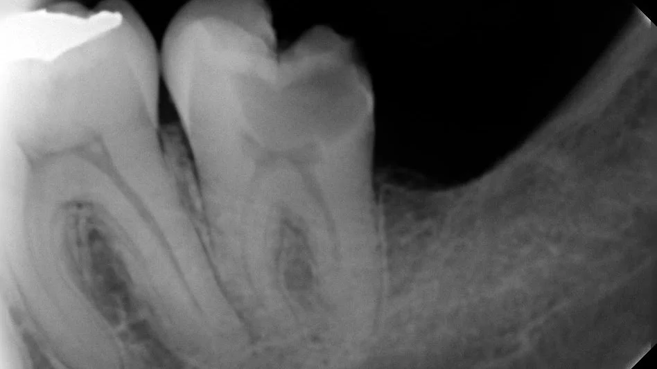Ilustración de tratamiento de endodoncia