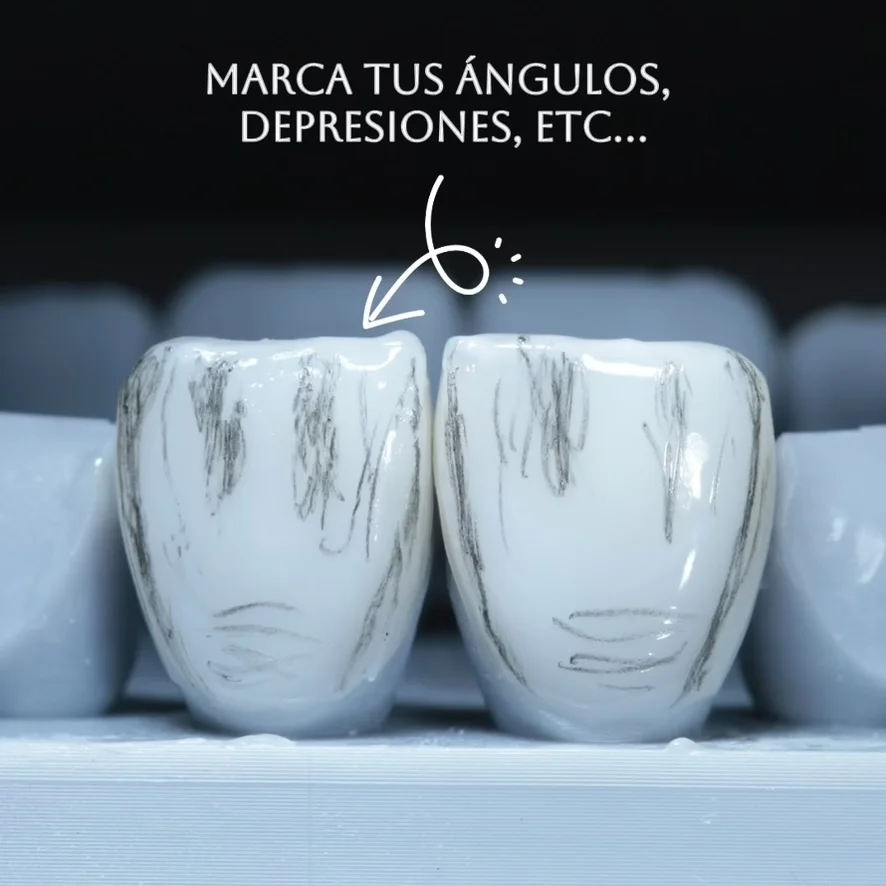 Diseño de sonrisa paso 13