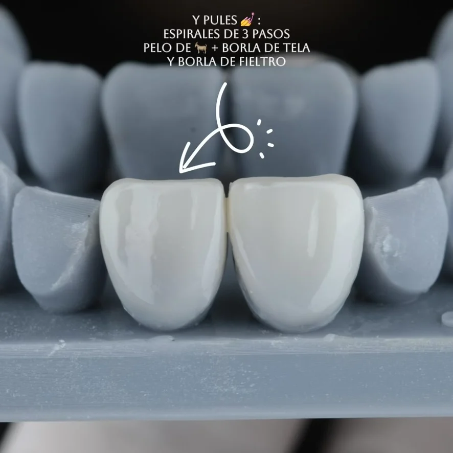 Diseño de sonrisa paso 14