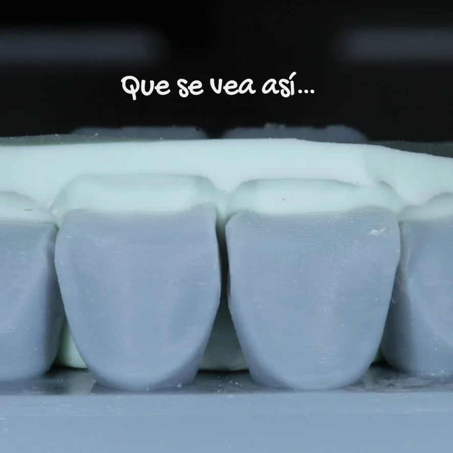 Diseño de sonrisa paso 4