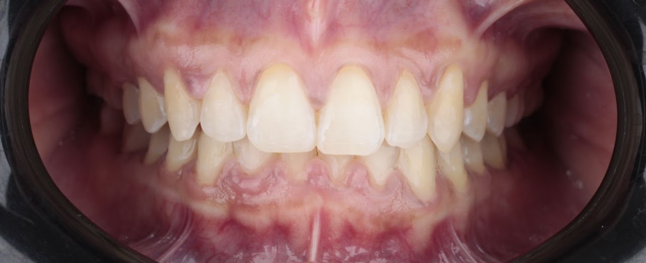 Endodoncia