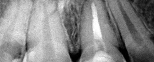 Endodoncia