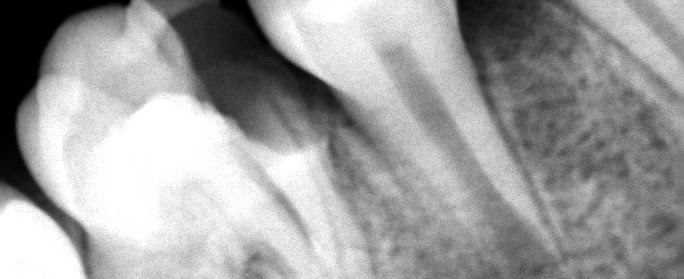 Extracción dental en Veracruz