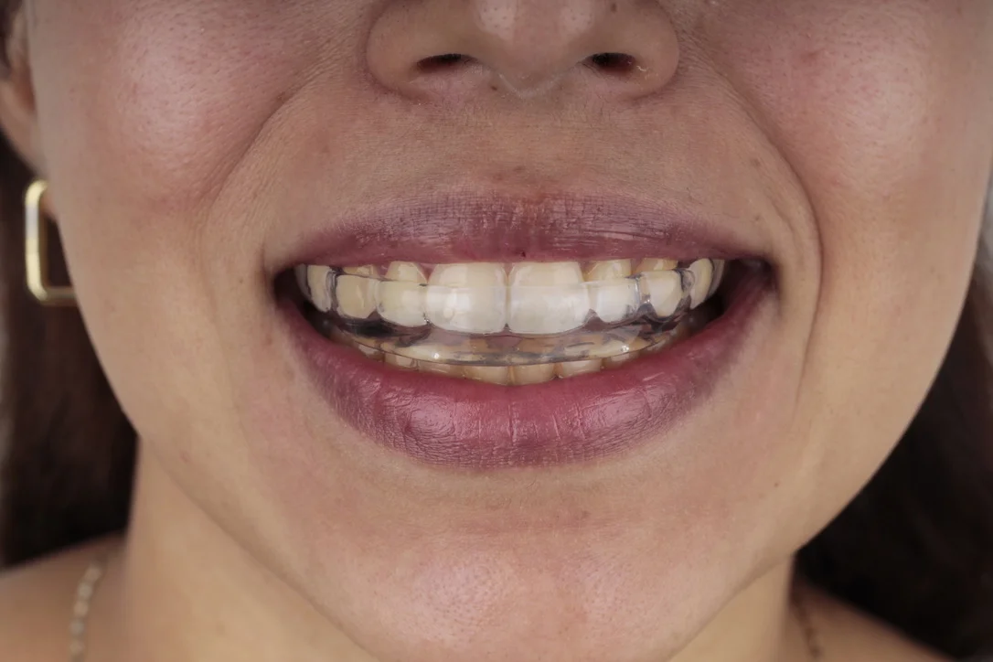 Guarda oclusal nocturna para bruxismo y rechinido dental — dentista en Veracruz, férula transparente a la medida