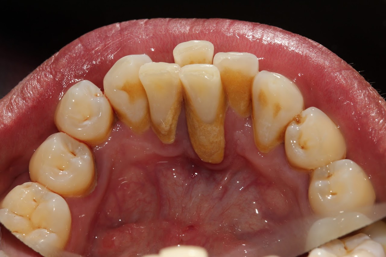 Sarro dental antes de limpieza