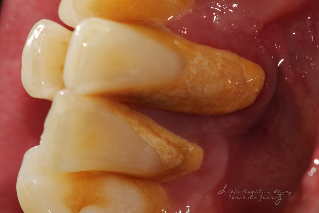 Sarro dental en incisivos