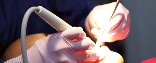 Limpieza dental ultrasónica