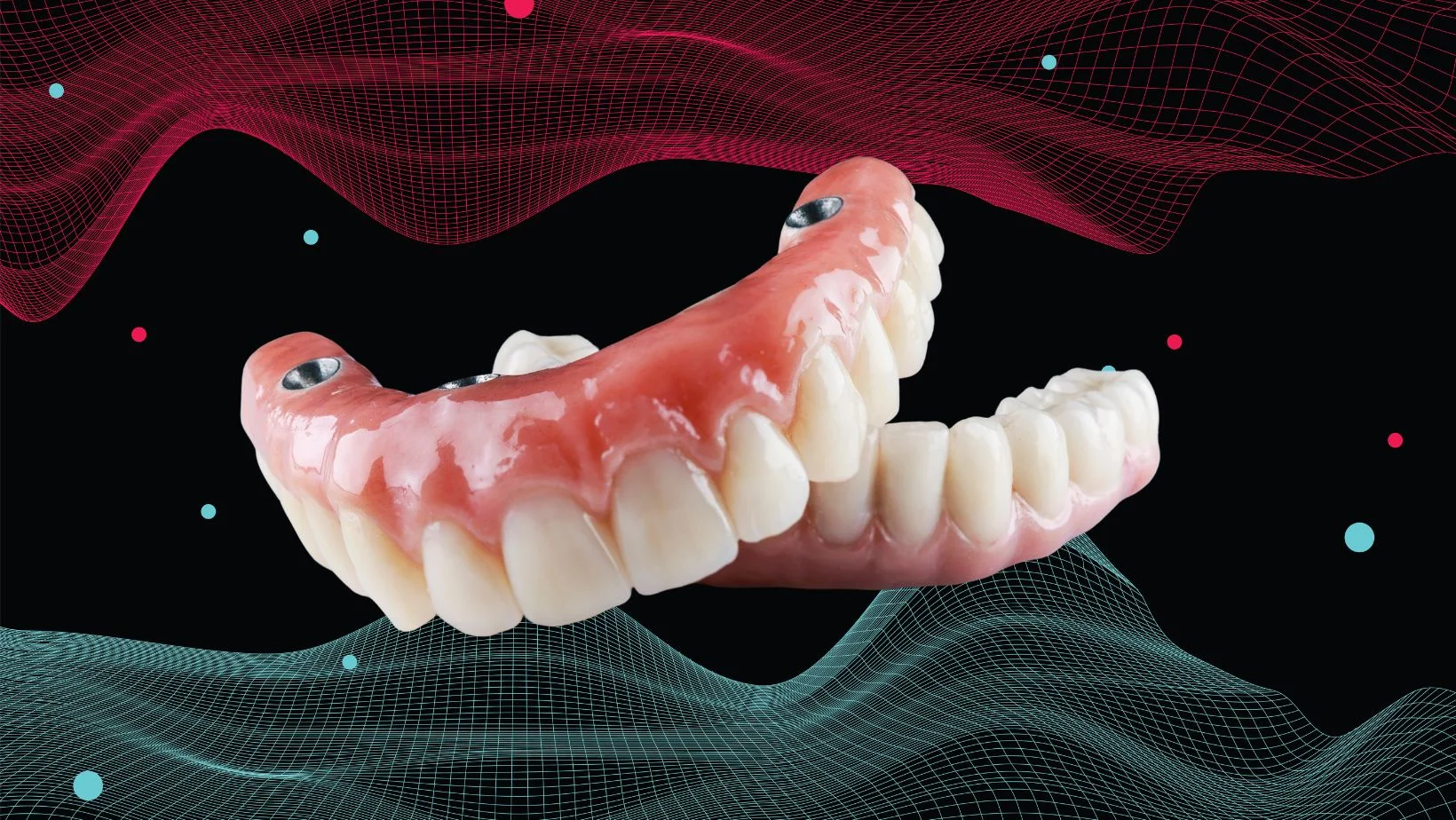 Prótesis sobre implantes en Veracruz: híbridas atornilladas u overdenture