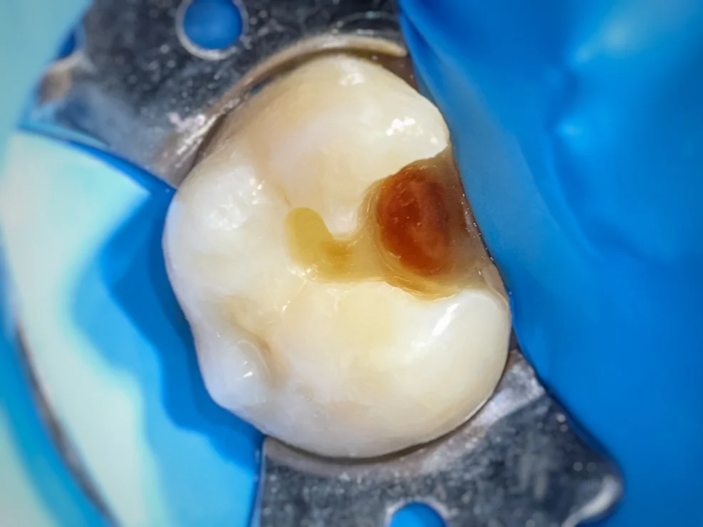 Remoción de caries