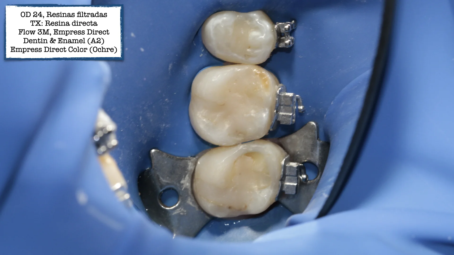Resina dental - Caso 1a