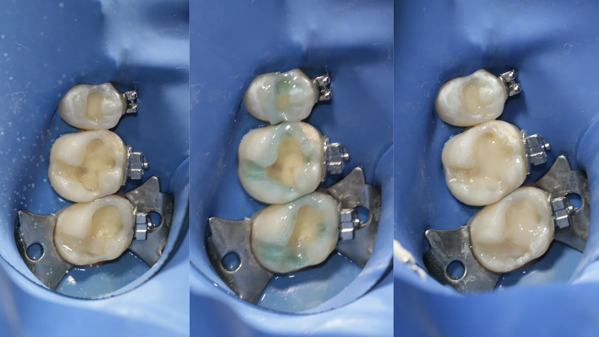 Resina dental - Caso 1b