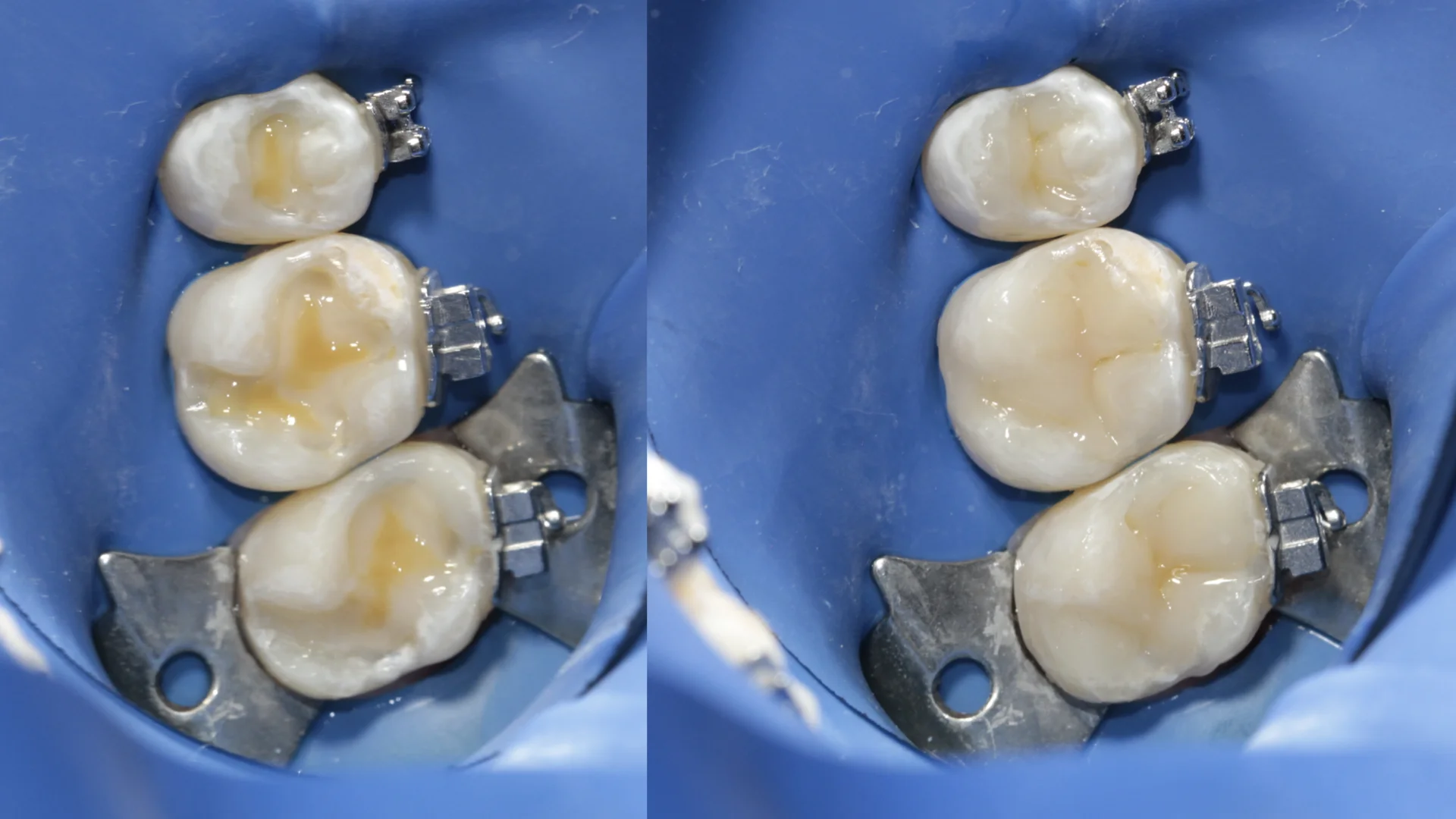 Resina dental - Caso 1c