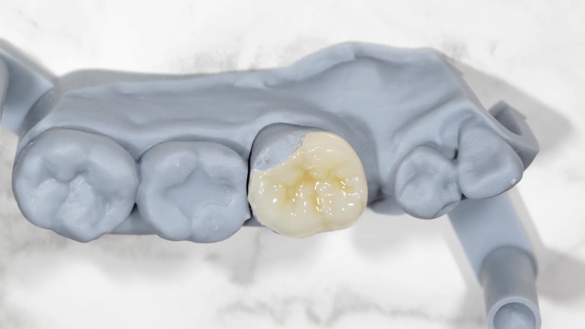 Resina dental - Caso 2d