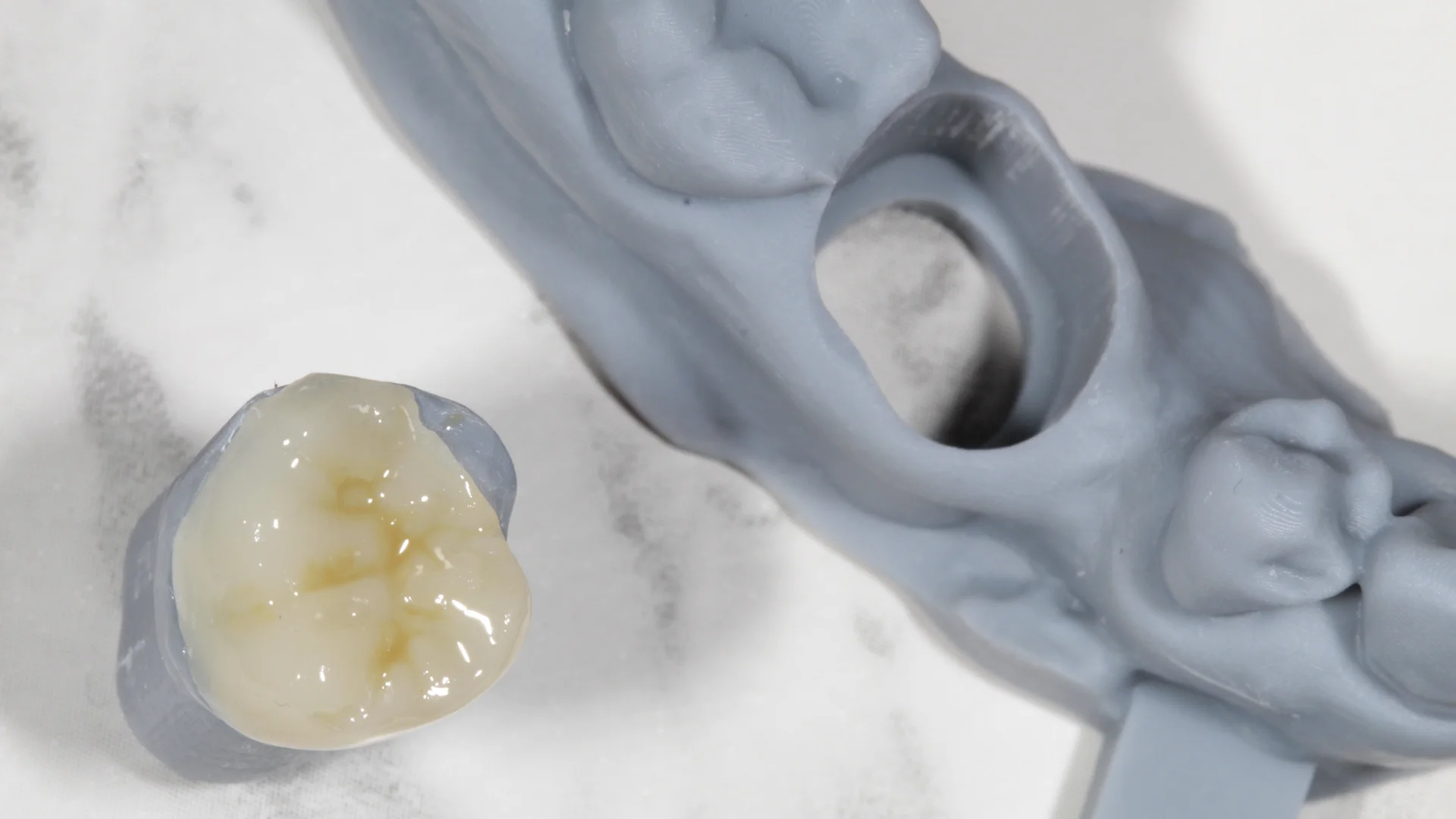 Resina dental - Caso 2e