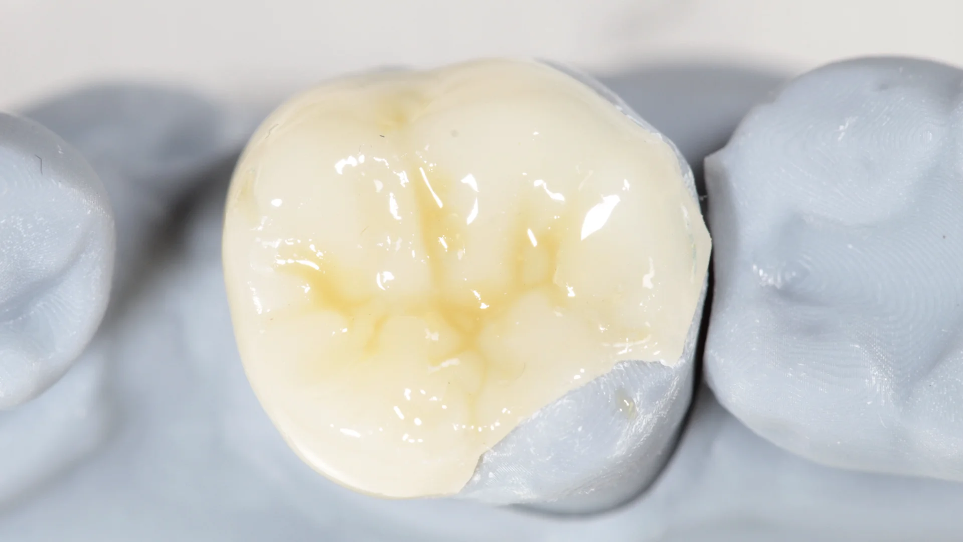 Resina dental - Caso 2f