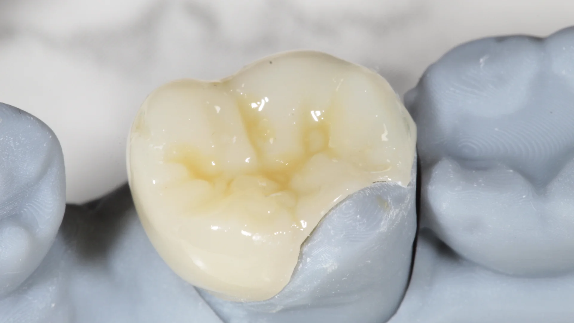 Resina dental - Caso 2g