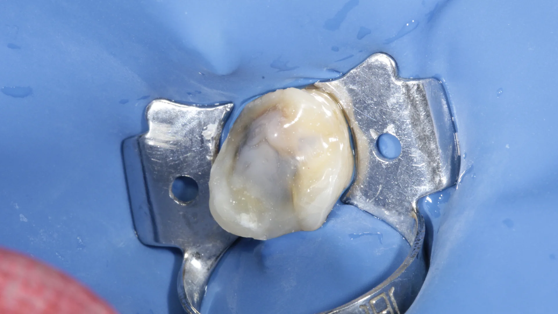 Resina dental - Caso 2h