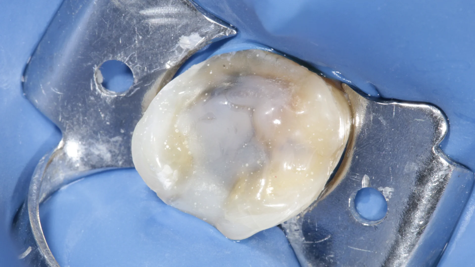 Resina dental - Caso 2i