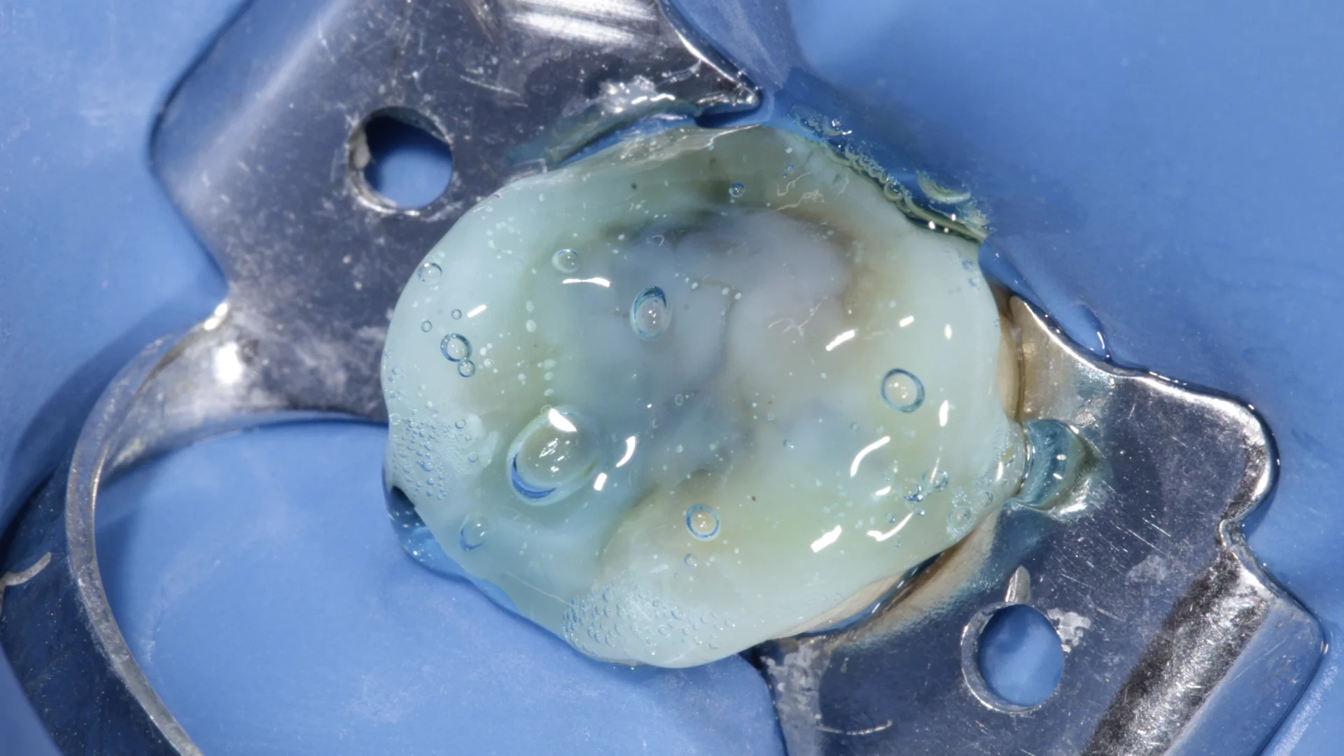 Resina dental - Caso 2j