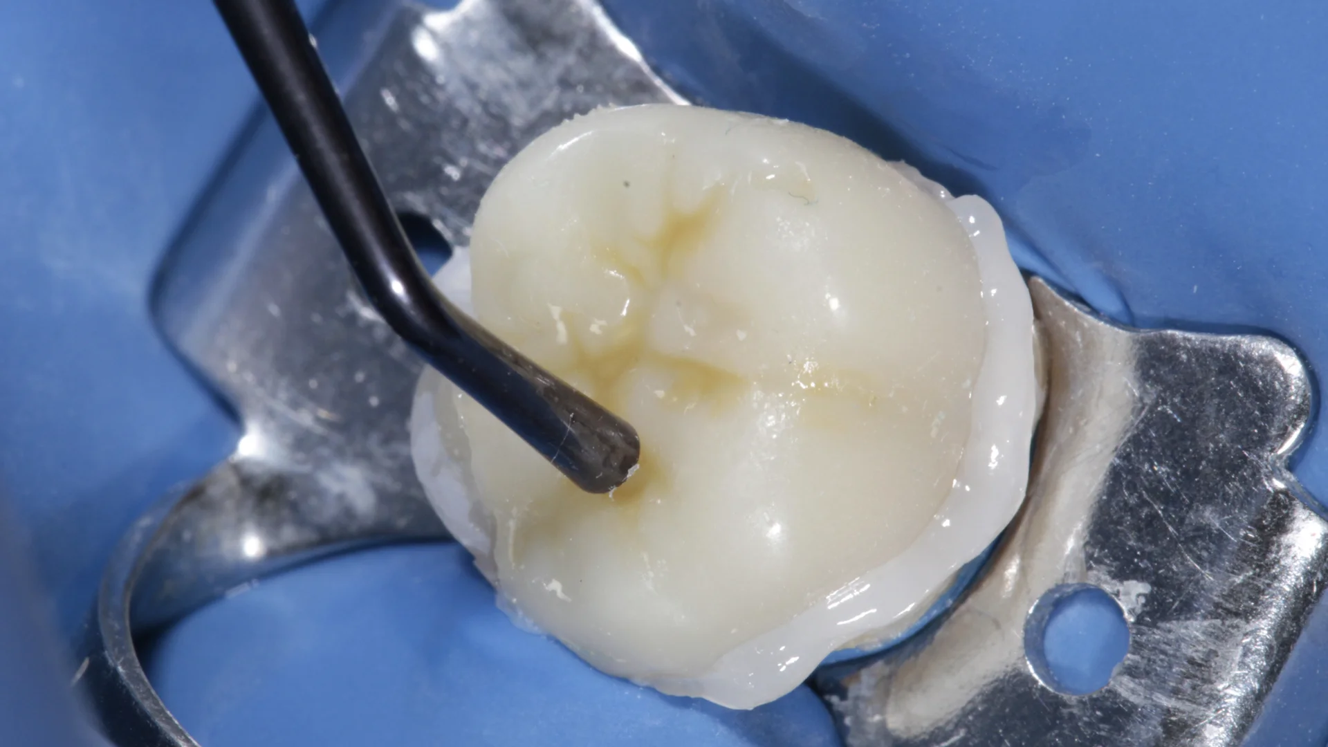 Resina dental - Caso 2k
