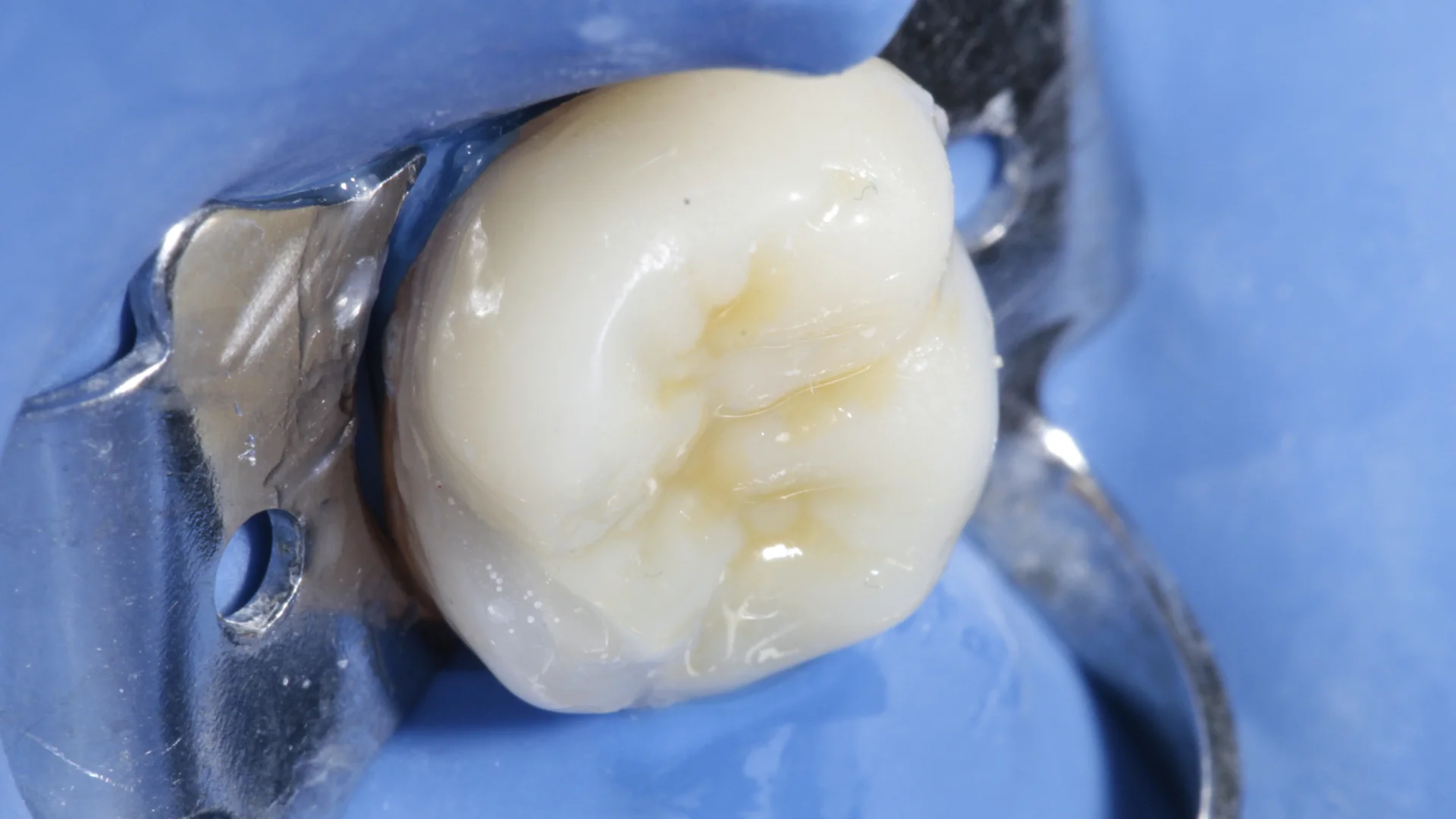 Resina dental - Caso 2o