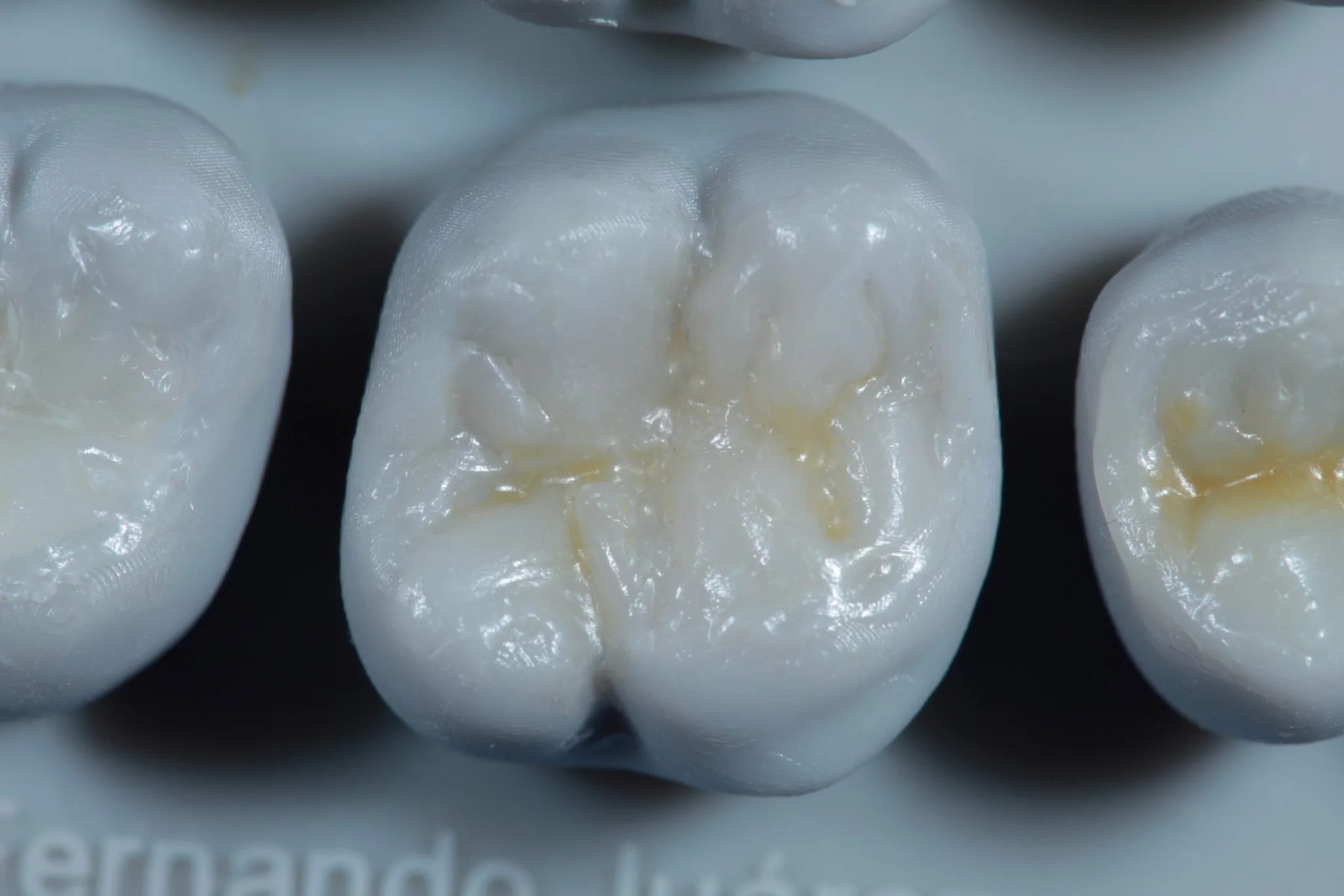 Modelado con resina dental - Dentista Veracruz