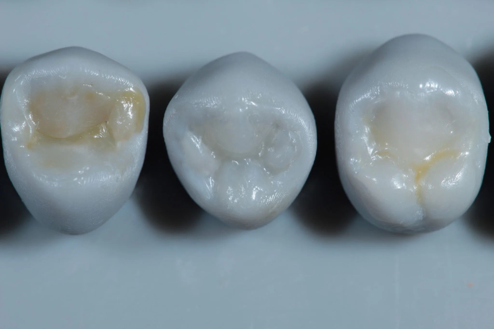 Modelado con resina dental - Dentista Veracruz