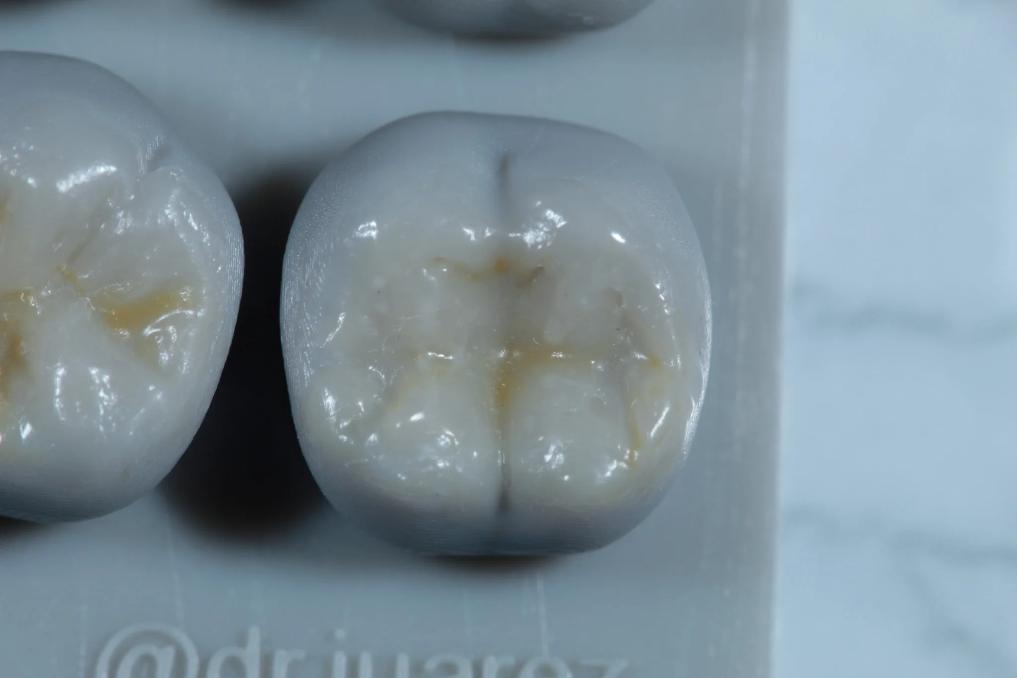 Modelado con resina dental - Dentista Veracruz