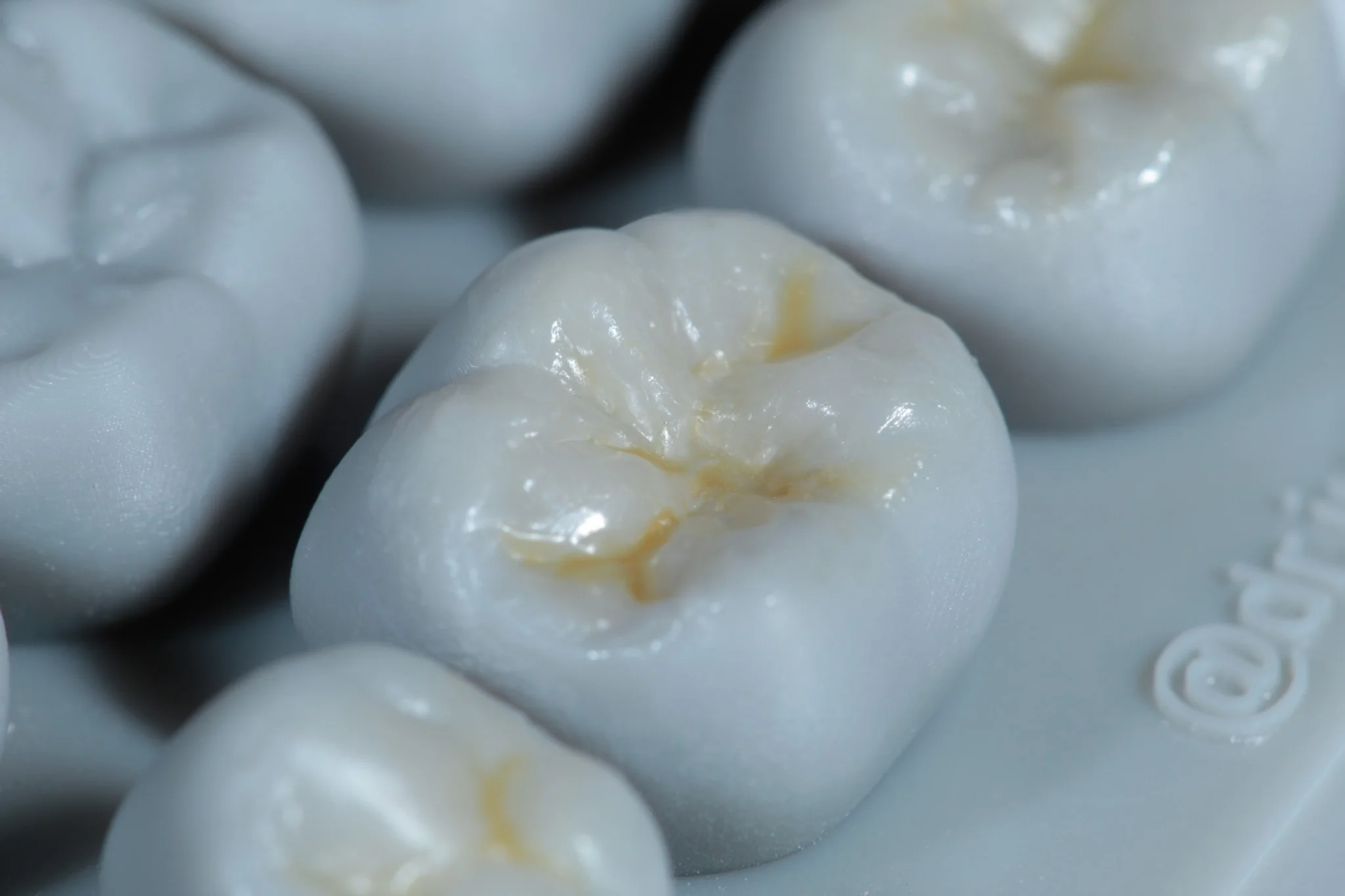 Modelado con resina dental - Dentista Veracruz
