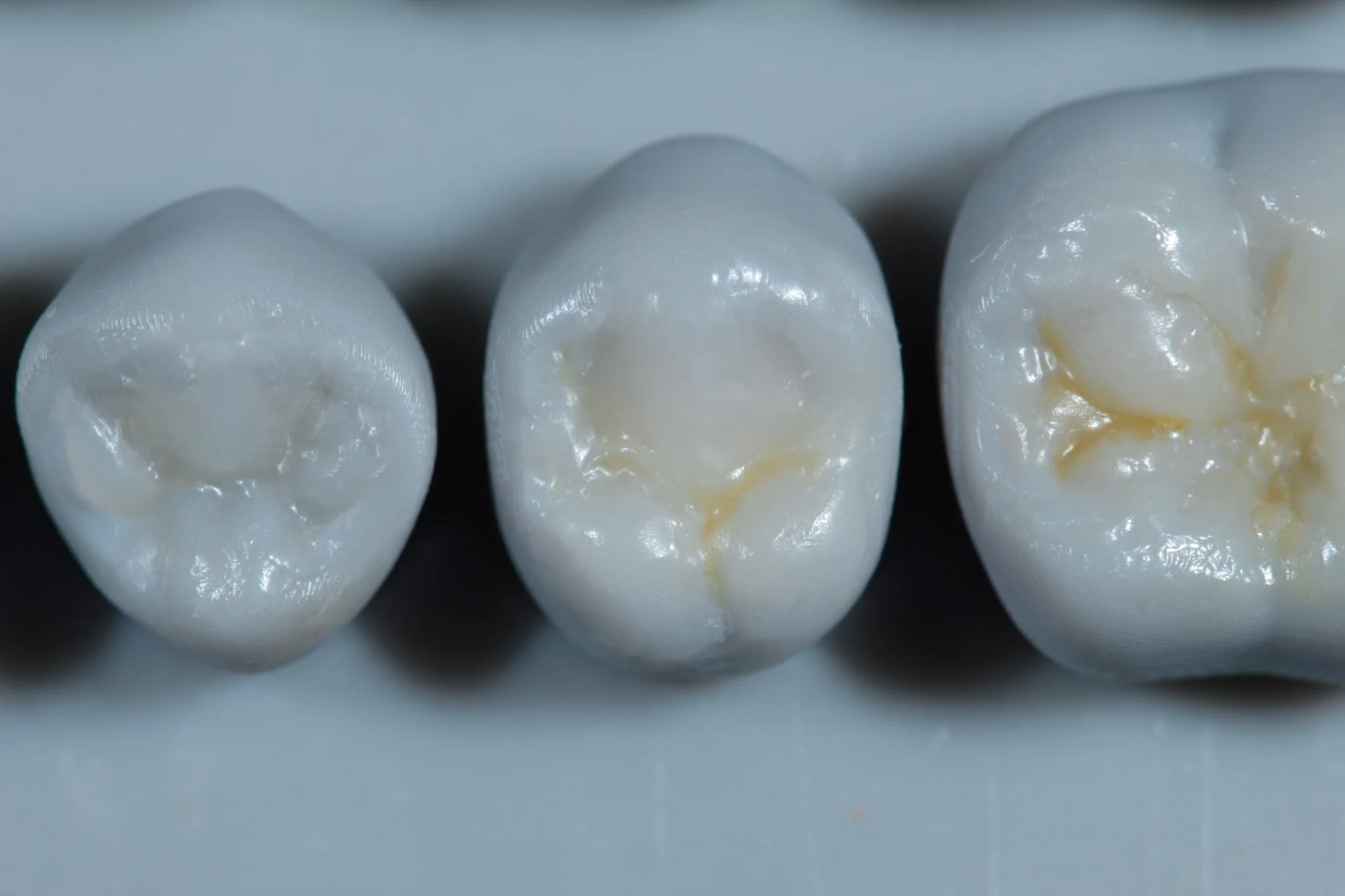 Modelado con resina dental - Dentista Veracruz