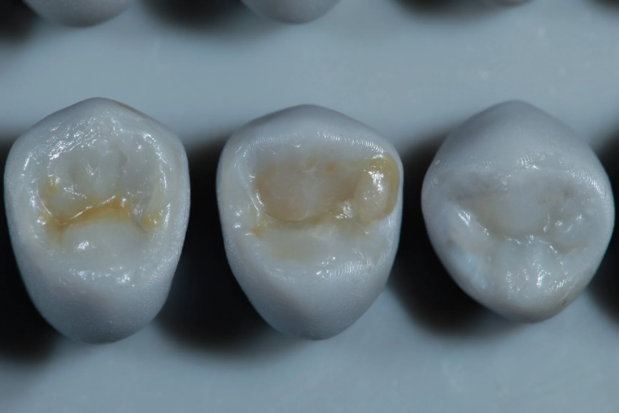 Modelado con resina dental - Dentista Veracruz