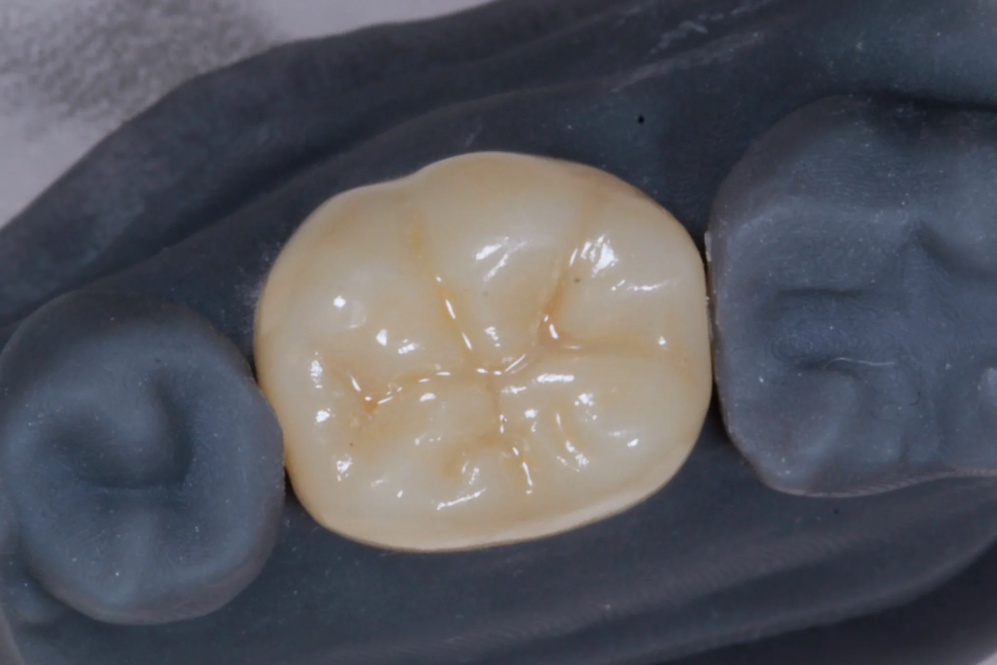 Corona de zirconia estética y resistente en Veracruz
