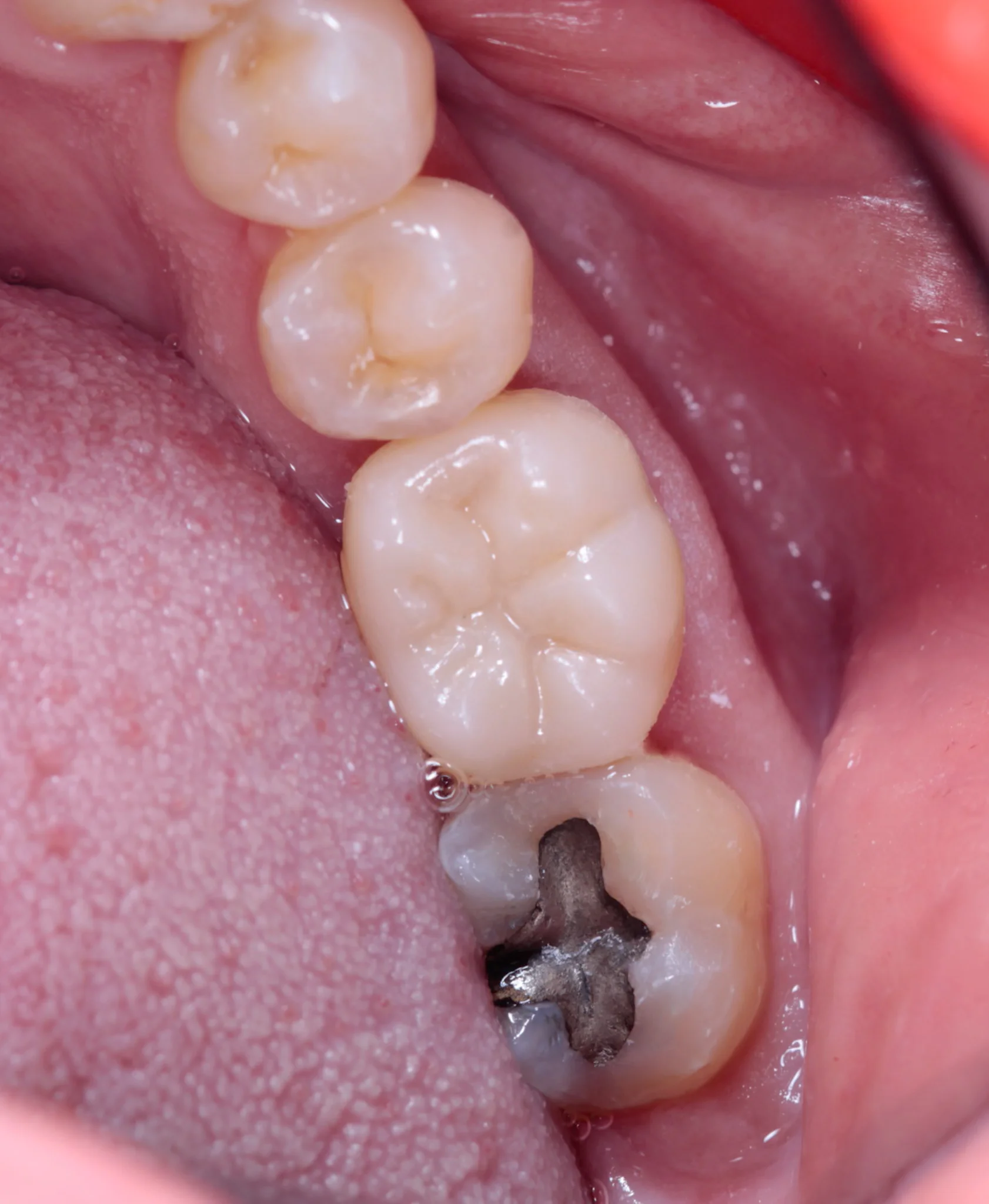 Corona de zirconia en molar — antes y después