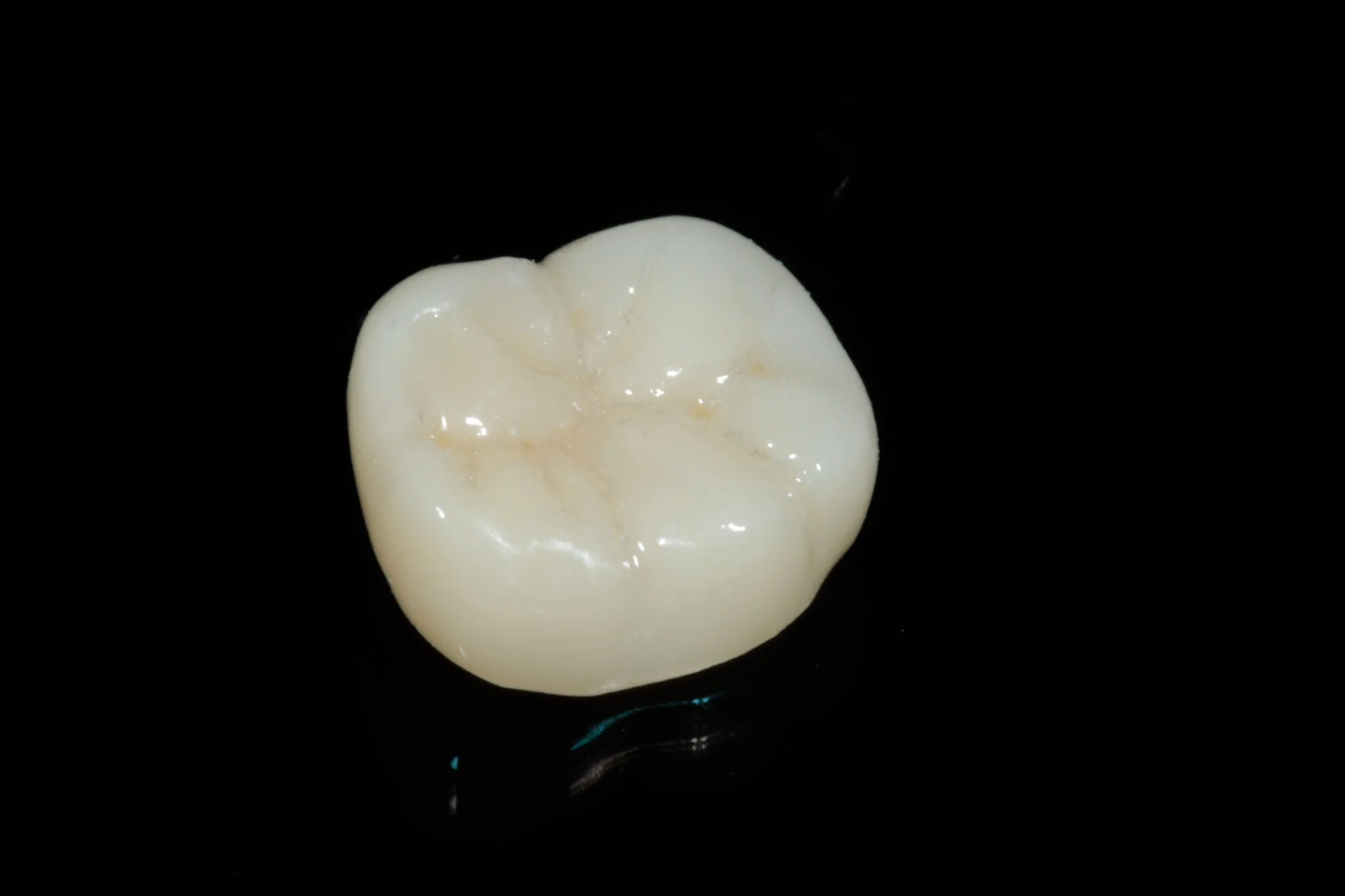 Corona de zirconia — ajuste y estética en premolar